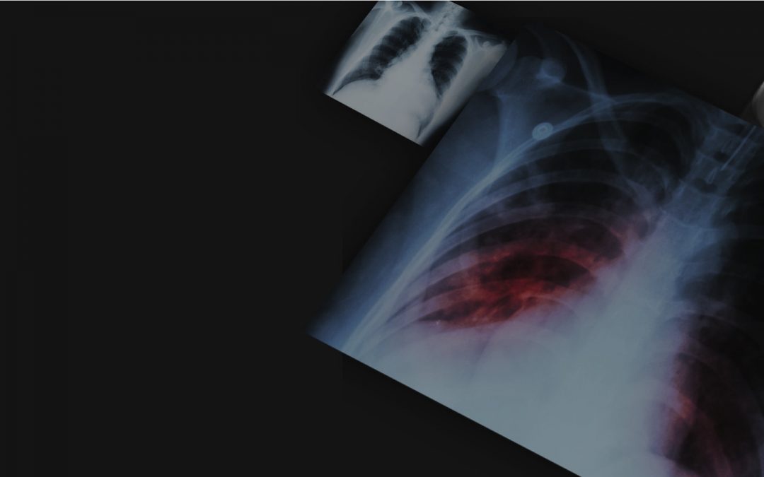 Chest radiograph