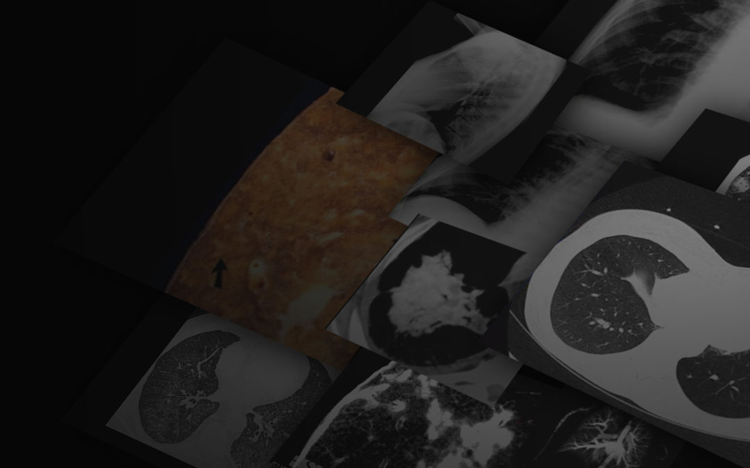 Chest Imaging: Pneumonia