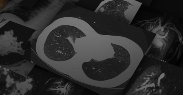 Chest Imaging: Pneumonia